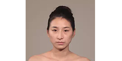 玻尿酸全臉填充術(shù)前