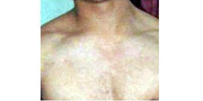 種植胸毛術(shù)前