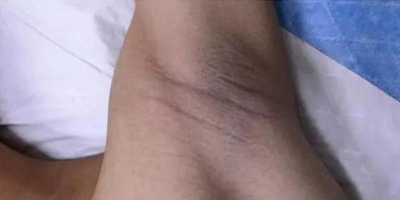 黃金微針除腋臭術(shù)前