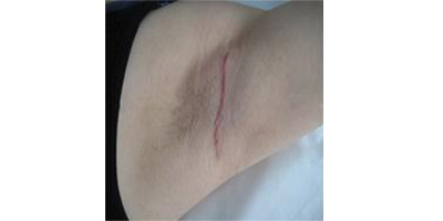 手術(shù)除腋臭術(shù)后