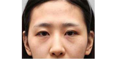 膠原蛋白豐淚溝術前