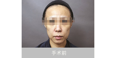 自體脂肪存儲術(shù)前