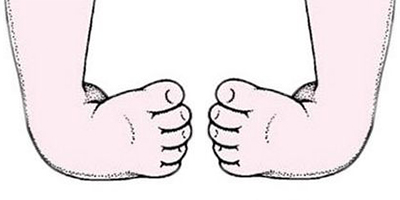 足內(nèi)翻矯正術前