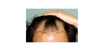種植發(fā)際線術(shù)前