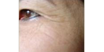 玻尿酸去靜態(tài)紋術前