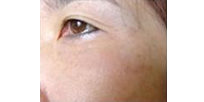 玻尿酸去靜態(tài)紋術后