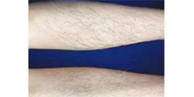 大小腿脫毛術(shù)前