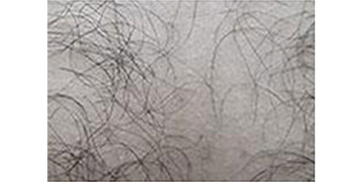 種植私密毛發(fā)術(shù)前