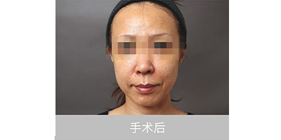 自體脂肪存儲術(shù)后