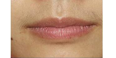 脫唇毛術(shù)前