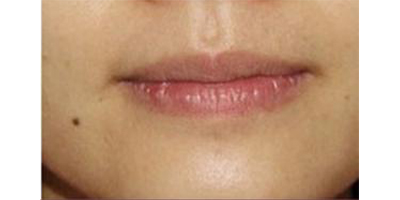 脫唇毛術(shù)后