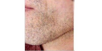 脫絡(luò)腮胡術(shù)前