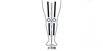 膝外翻矯正術(shù)后