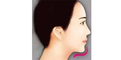 假體豐下巴術后