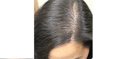 頭頂加密種植術(shù)后