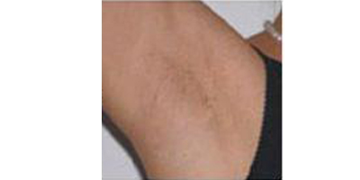 激光除腋臭術后