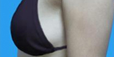 自體脂肪隆胸術前