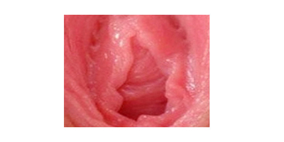 處女膜修復(fù)術(shù)前