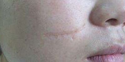 手術(shù)祛疤術(shù)前