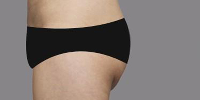 自體脂肪豐臀術前