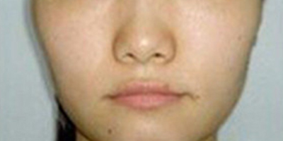 自體脂肪全臉填充術前