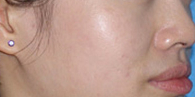 光子嫩膚術(shù)后