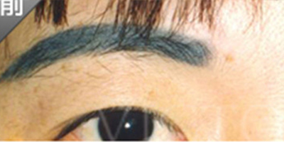 洗眉術前