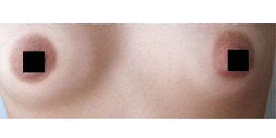 乳暈縮小術(shù)前