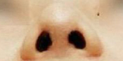 鼻部硅膠假體取出術(shù)后