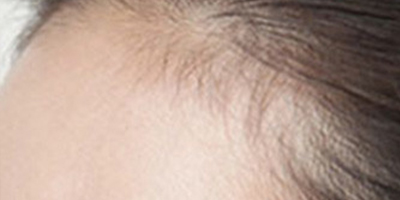 半永久發(fā)際線術(shù)前