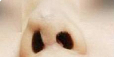 鼻部硅膠假體取出術(shù)前