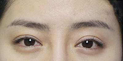 自體脂肪豐眉弓術(shù)前