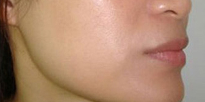 C10祛斑術(shù)后