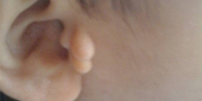 副耳去除術(shù)術(shù)前