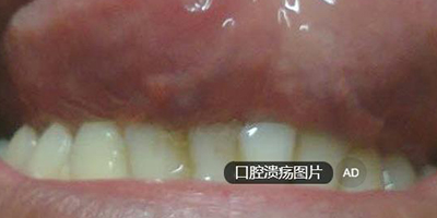 口腔潰瘍術(shù)后