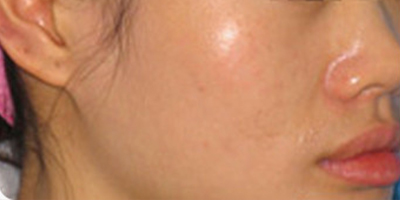 光子嫩膚術(shù)前