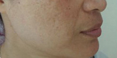 C10祛斑術(shù)前