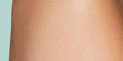 激光去紋身術(shù)后