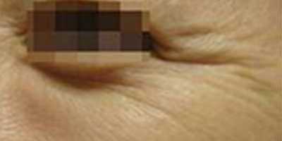 注射去魚(yú)尾紋術(shù)前