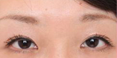 假體墊眉弓術(shù)后