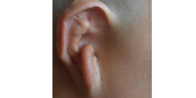 耳再造術(shù)前