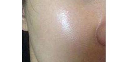 無針?biāo)庑g(shù)后