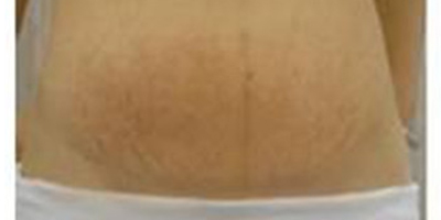 去妊娠紋術(shù)前