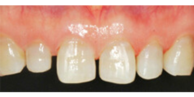 全瓷牙術前