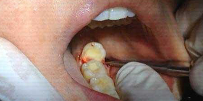 拔智齒術(shù)前