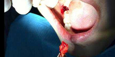 拔智齒術(shù)后