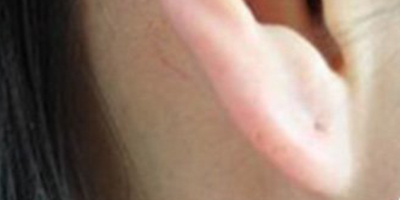 玻尿酸豐耳垂術后