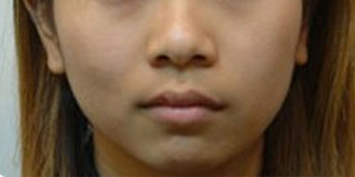 自體脂肪豐面頰術前