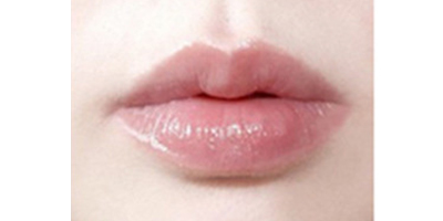 M唇手術(shù)術(shù)后