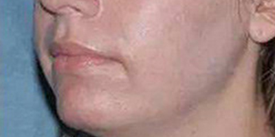 E光祛斑術(shù)后